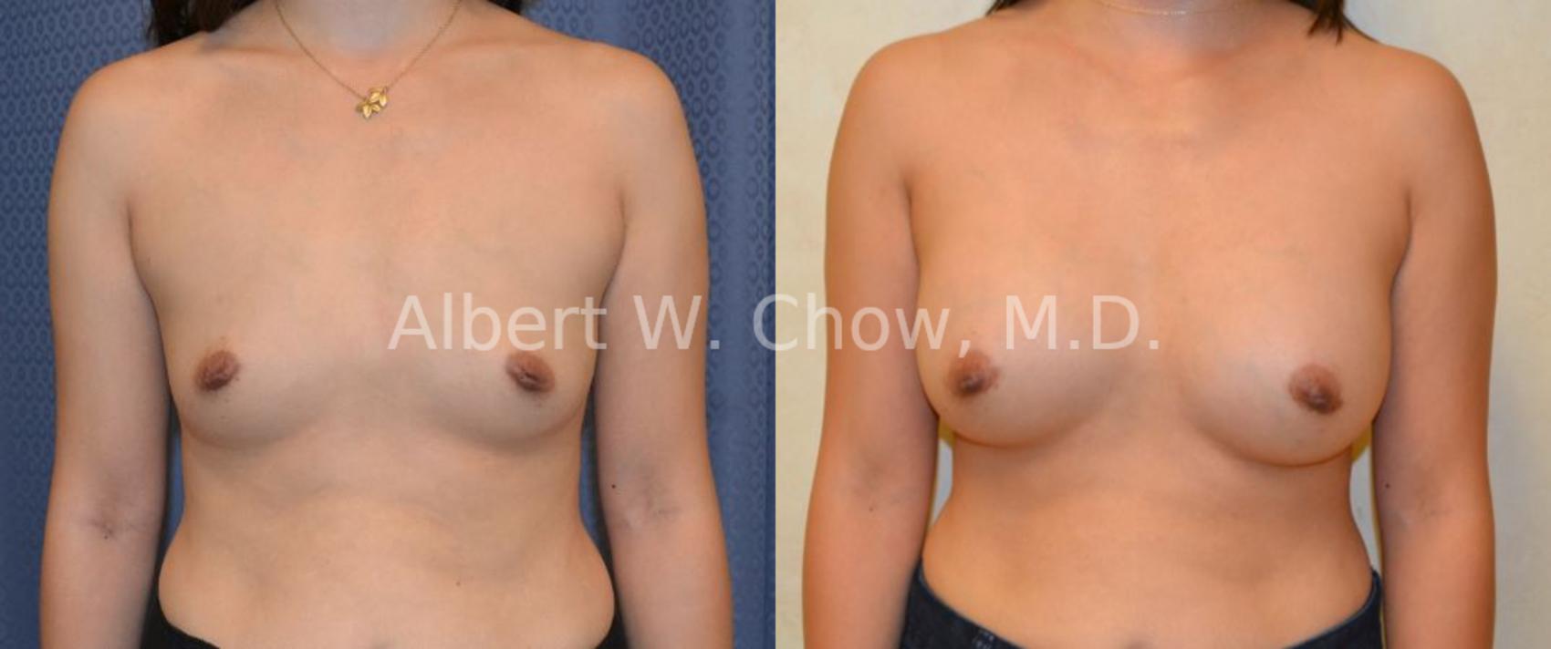Before & After Breast Augmentation Case 33 View #1 View in San Francisco, CA