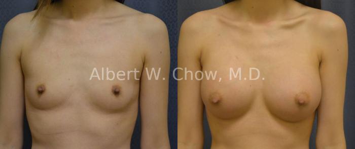 Before & After Breast Augmentation Case 38 View #1 View in San Francisco, CA