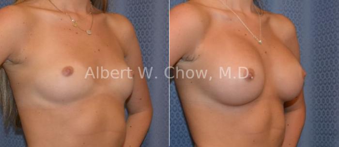 Before & After Breast Augmentation Case 39 View #1 View in San Francisco, CA