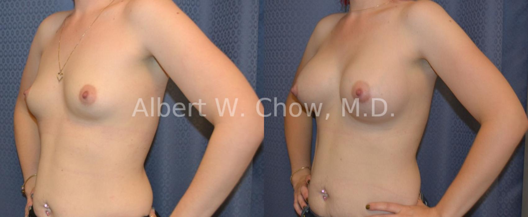 Before & After Breast Augmentation Case 46 View #1 View in San Francisco, CA