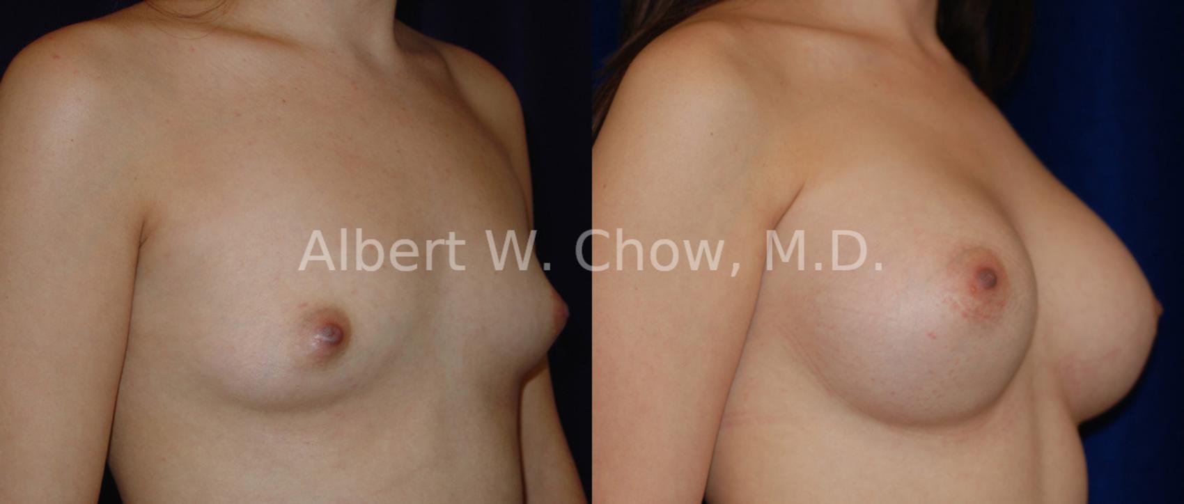 Before & After Breast Augmentation Case 8 View #1 View in San Francisco, CA
