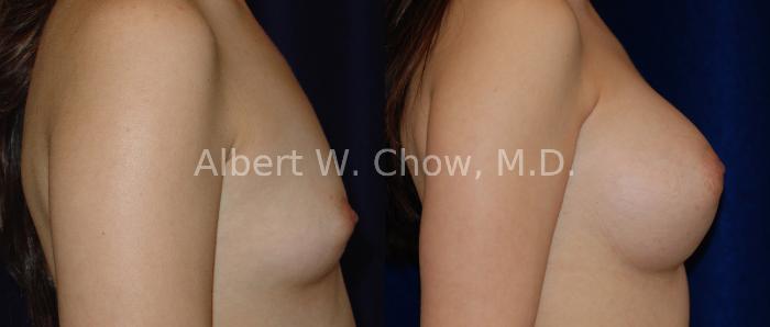 Before & After Breast Augmentation Case 8 View #2 View in San Francisco, CA