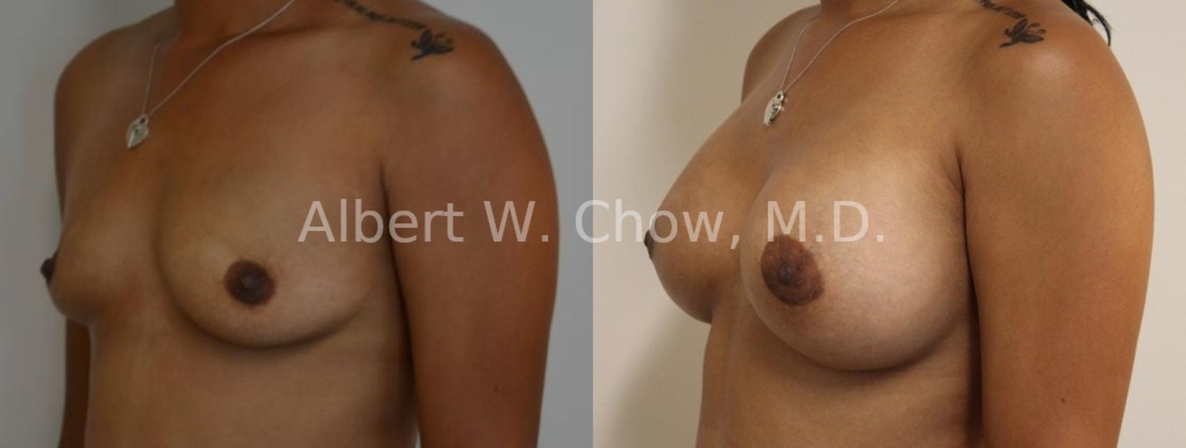 Before & After Breast Augmentation Case 82 View #1 View in San Francisco, CA