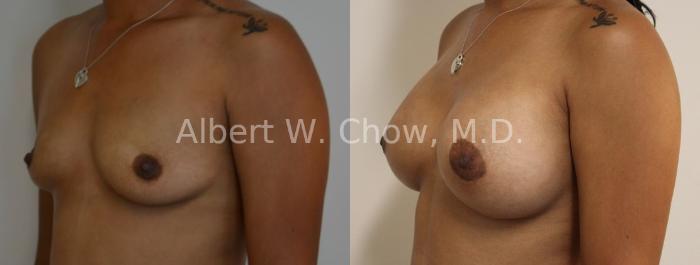 Before & After Breast Augmentation Case 82 View #1 View in San Francisco, CA