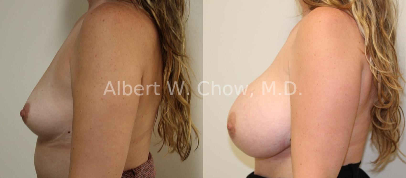 Before & After Breast Augmentation Case 83 View #1 View in San Francisco, CA