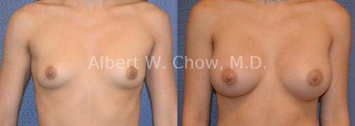 Before & After Breast Augmentation Case 85 View #1 View in San Francisco, CA