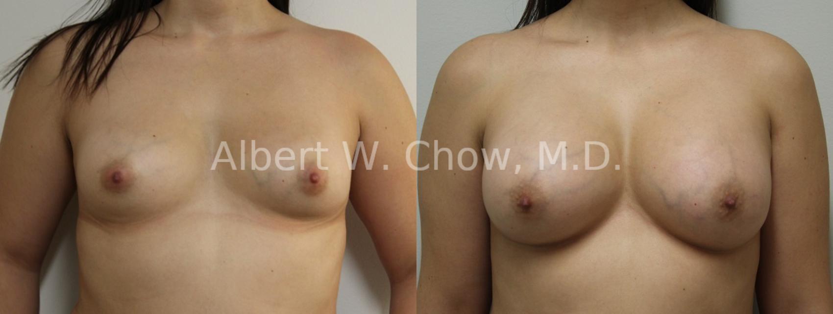 Before & After Breast Augmentation Case 87 View #1 View in San Francisco, CA