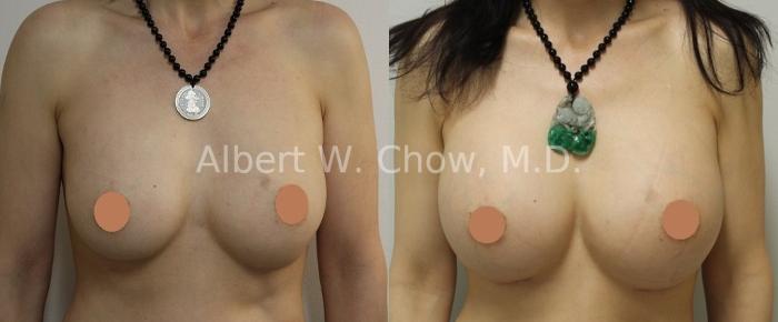 Before & After Breast Augmentation Case 88 View #1 View in San Francisco, CA