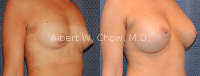 Before & After Breast Augmentation Case 9 View #1 View in San Francisco, CA