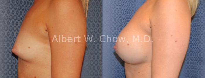 Before & After Breast Augmentation Case 9 View #2 View in San Francisco, CA