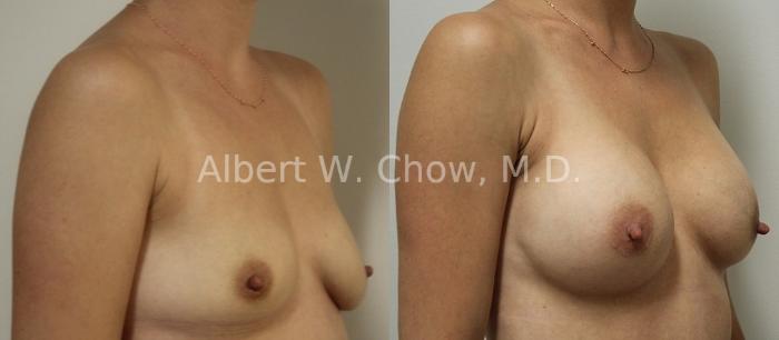 Before & After Breast Augmentation Case 91 View #1 View in San Francisco, CA
