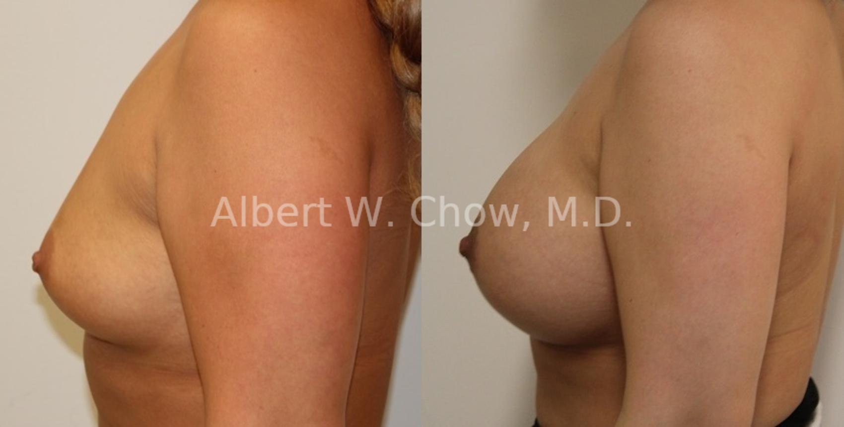 Before & After Breast Augmentation Case 92 View #1 View in San Francisco, CA