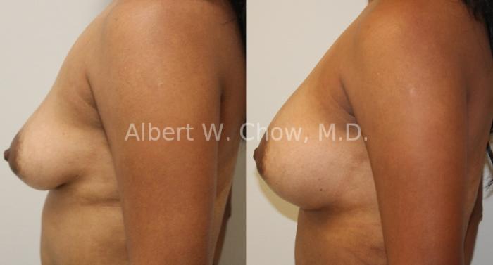 Before & After Breast Augmentation Case 93 View #1 View in San Francisco, CA