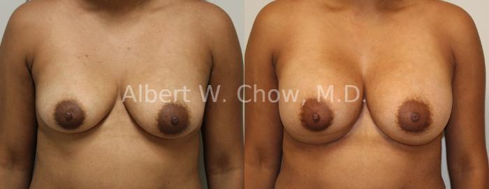 Before & After Breast Augmentation Case 94 View #1 View in San Francisco, CA