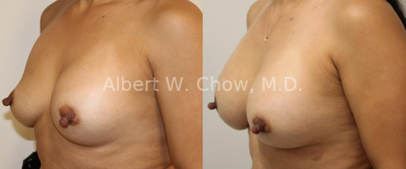 Before & After Breast Augmentation Case 96 View #1 View in San Francisco, CA