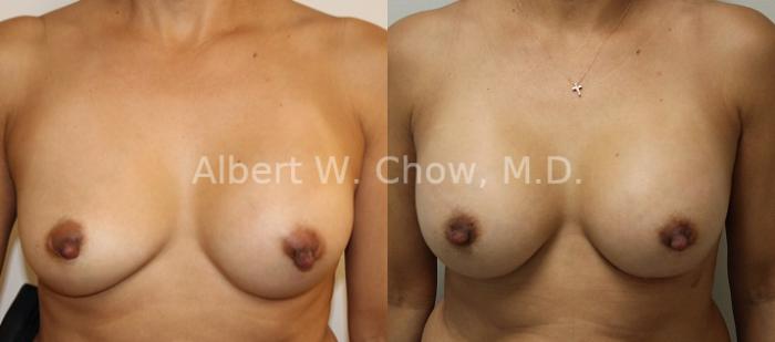 Before & After Breast Augmentation Case 97 View #1 View in San Francisco, CA