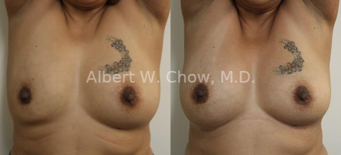 Before & After Breast Augmentation Case 98 View #1 View in San Francisco, CA