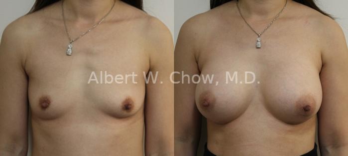 Before & After Breast Augmentation Case 99 View #1 View in San Francisco, CA