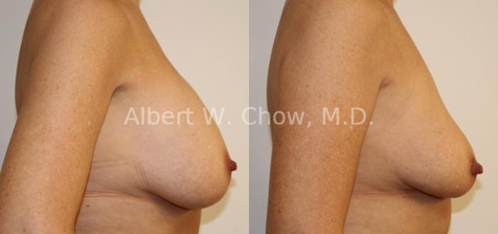 Before & After Breast Implant Removal Case 104 View #1 View in San Francisco, CA