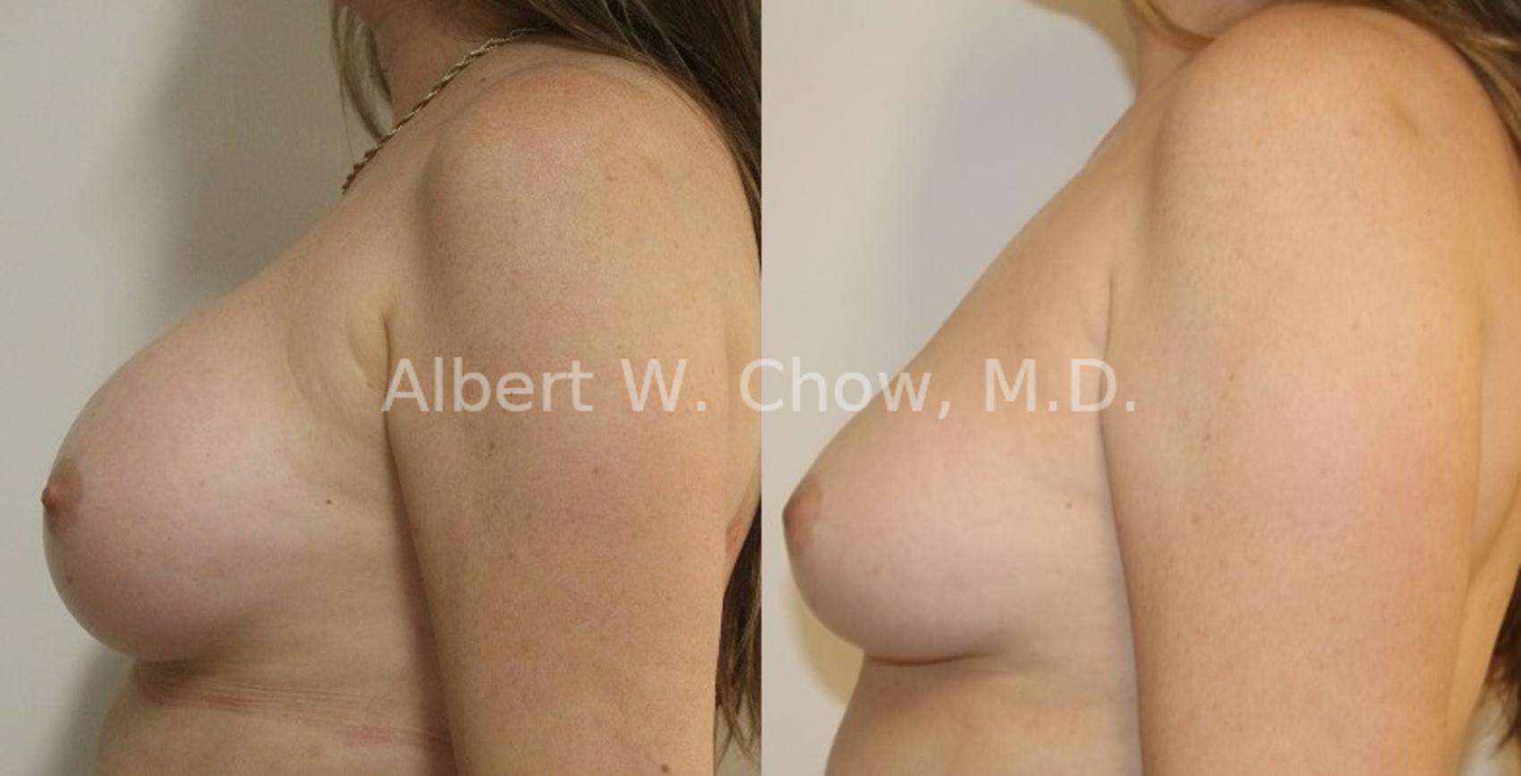 Before & After Breast Implant Removal Case 117 View #1 View in San Francisco, CA