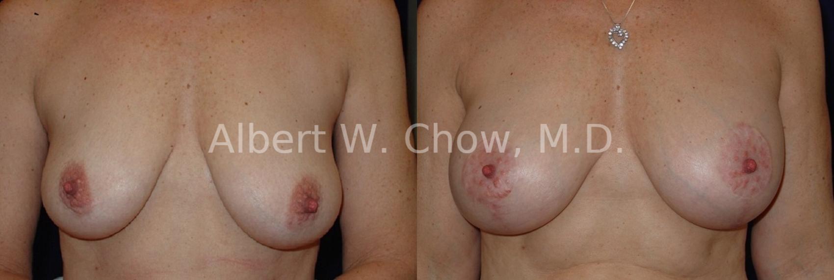 Before & After Breast Lift Case 71 View #1 View in San Francisco, CA