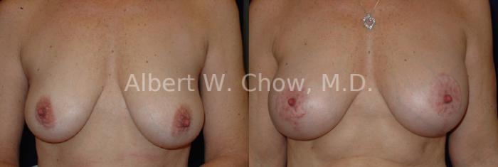 Before & After Breast Lift Case 71 View #1 View in San Francisco, CA