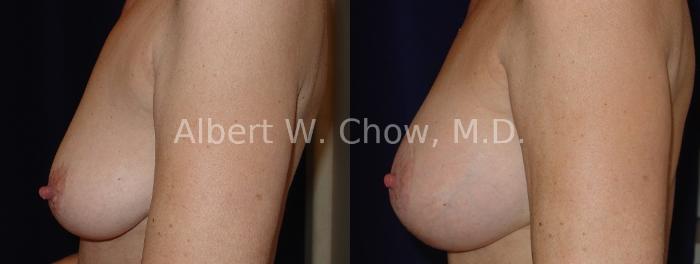 Before & After Breast Lift Case 72 View #1 View in San Francisco, CA