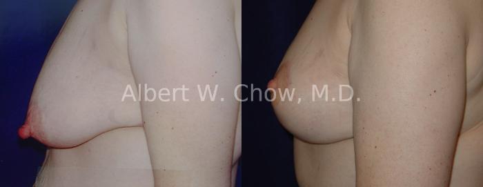 Before & After Breast Lift Case 73 View #1 View in San Francisco, CA