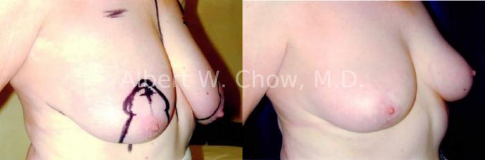 Before & After Breast Lift Case 81 View #1 View in San Francisco, CA