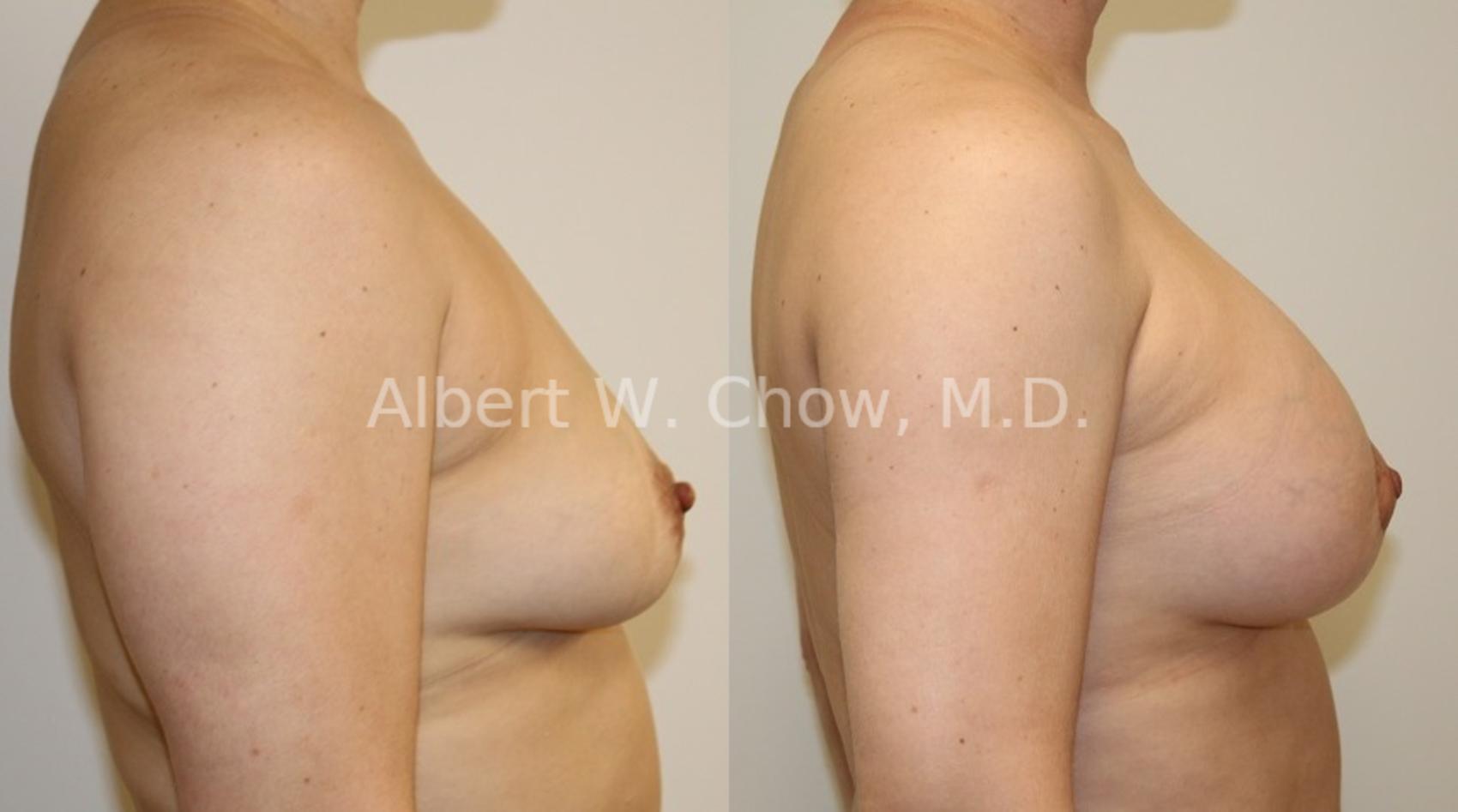Before & After Breast Lift Case 89 View #1 View in San Francisco, CA
