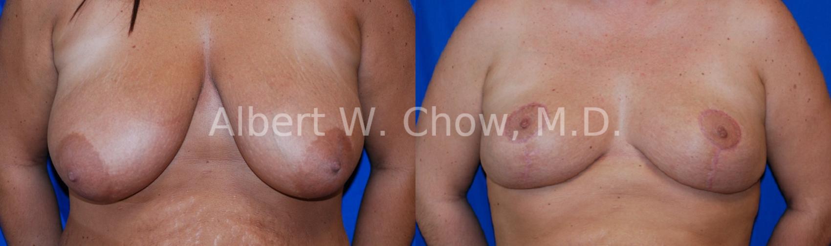 Before & After Breast Reduction Case 78 View #1 View in San Francisco, CA