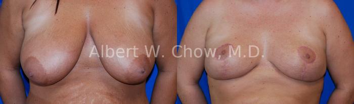 Before & After Breast Reduction Case 78 View #1 View in San Francisco, CA