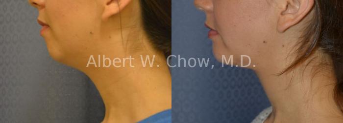 Before & After Chin Augmentation Case 37 View #1 View in San Francisco, CA