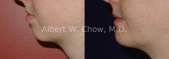Before & After Chin Augmentation Case 63 View #1 View in San Francisco, CA