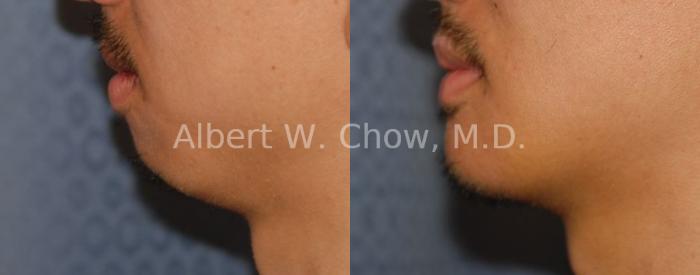Before & After Chin Augmentation Case 65 View #1 View in San Francisco, CA