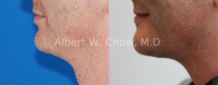 Before & After Chin Augmentation Case 66 View #1 View in San Francisco, CA