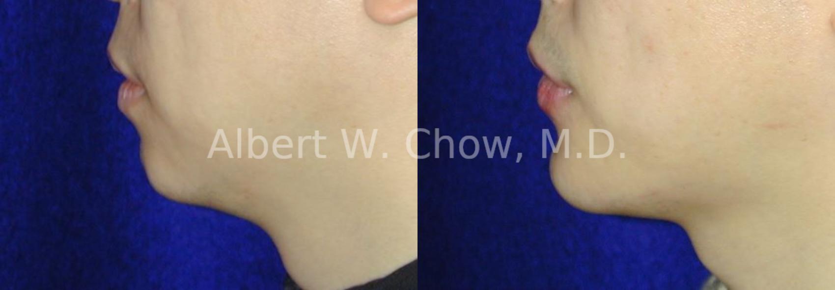 Before & After Chin Augmentation Case 67 View #1 View in San Francisco, CA