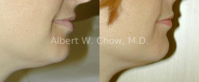 Before & After Chin Augmentation Case 68 View #1 View in San Francisco, CA