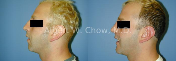 Before & After Chin Augmentation Case 69 View #1 View in San Francisco, CA