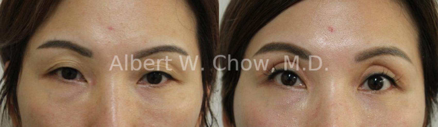 Before & After Eyelid Surgery Case 100 View #1 View in San Francisco, CA