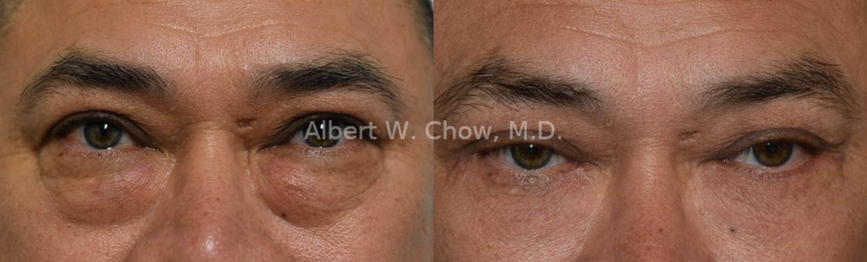 Lower Lid Blepharoplasty 
