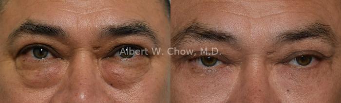 Lower Lid Blepharoplasty 