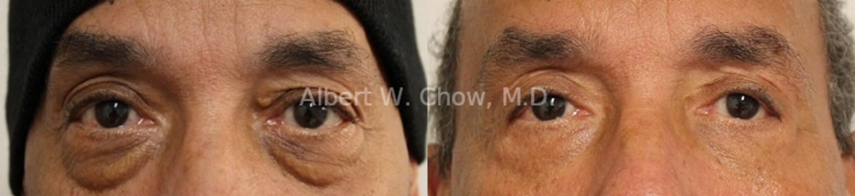 Lower Lid Blepharoplasty 