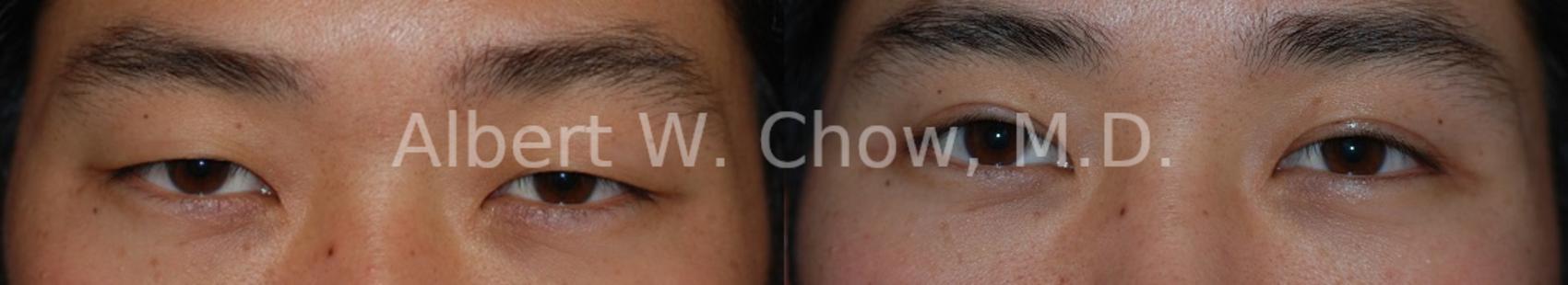 Before & After Eyelid Surgery Case 55 View #1 View in San Francisco, CA