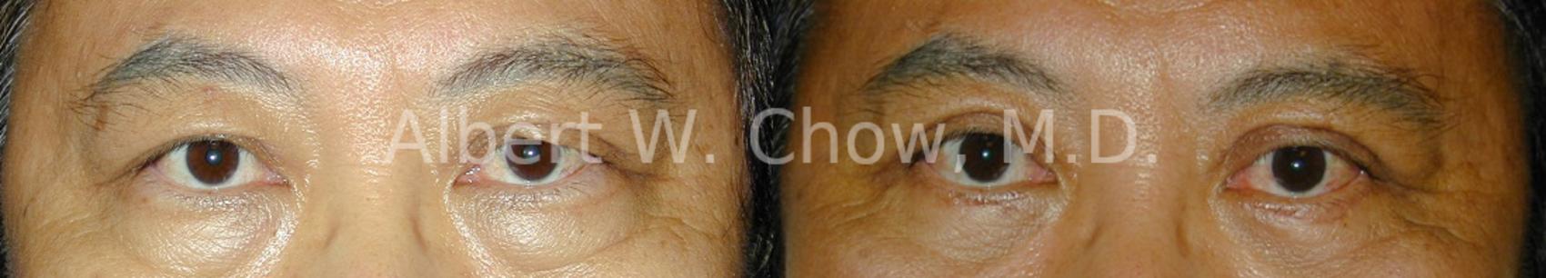 Before & After Eyelid Surgery Case 75 View #1 View in San Francisco, CA
