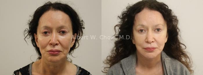 Facelift