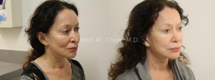 Facelift