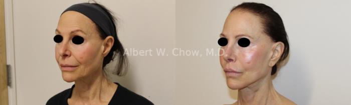 Facelift