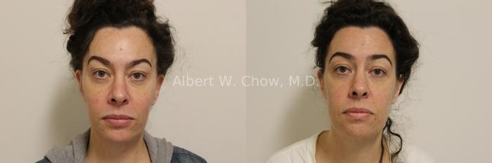 Facelift