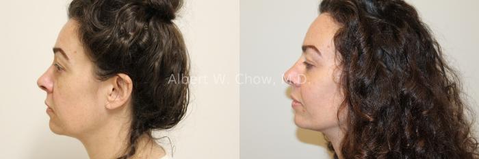 Facelift